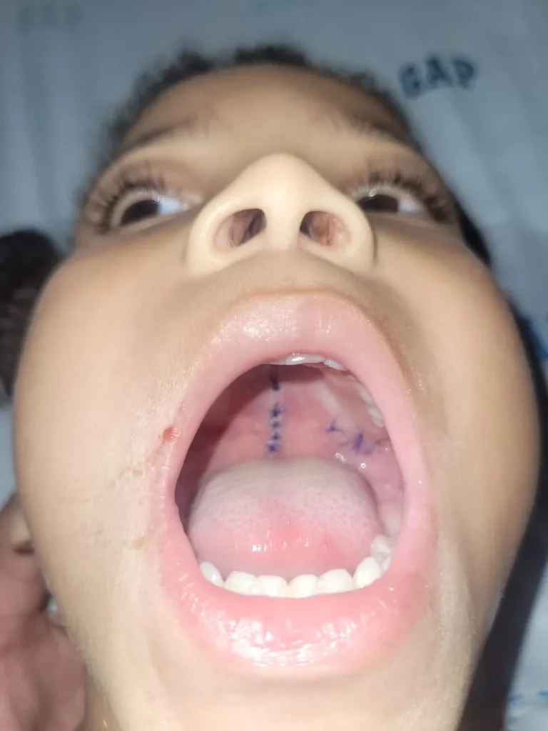 labio leporino